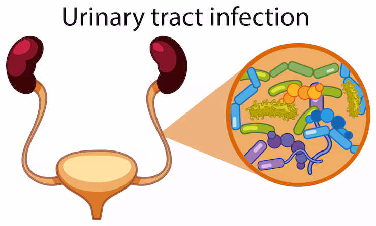 UTI Infection Treatment
