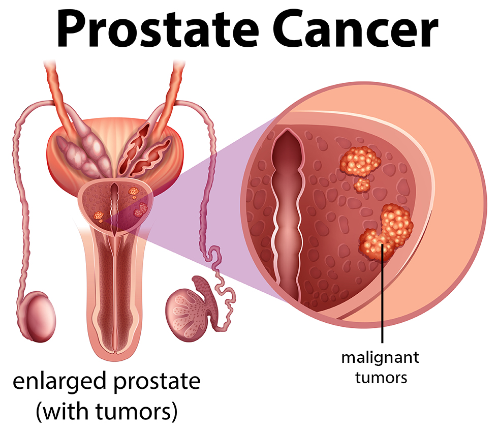 Prostate Cancer Treatment