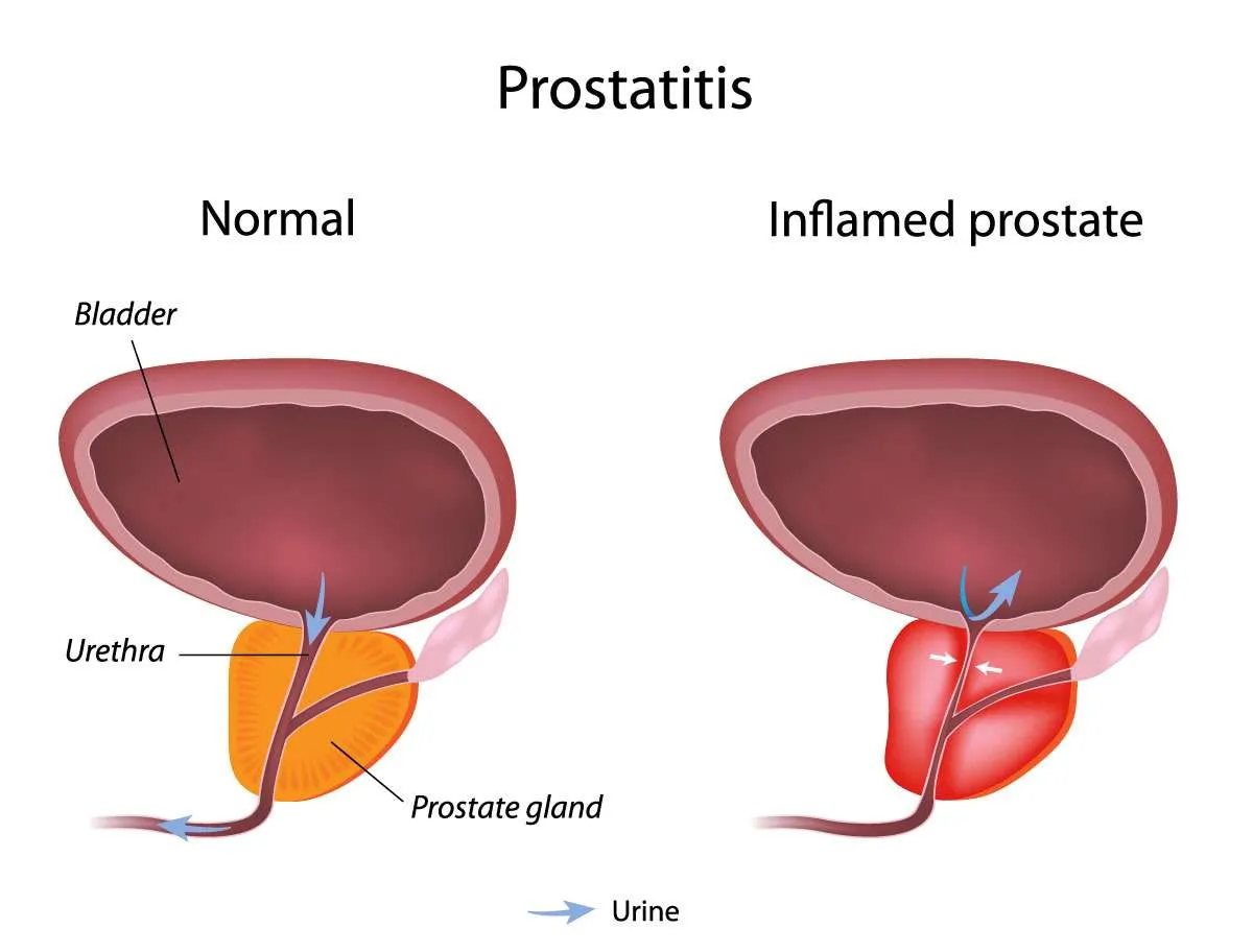 Prostatitis Treatment