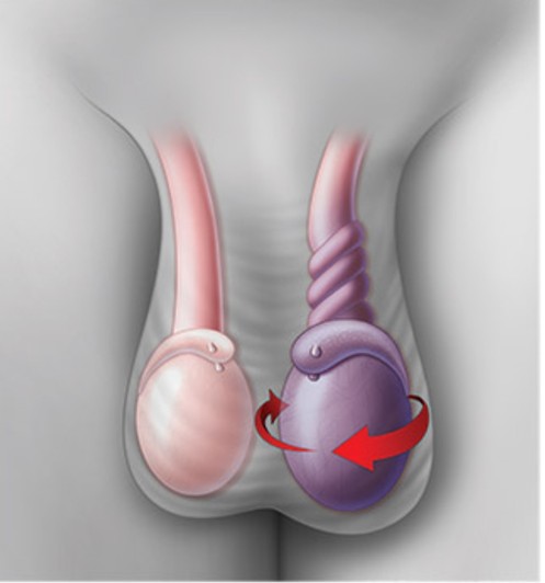 Torsion Testis