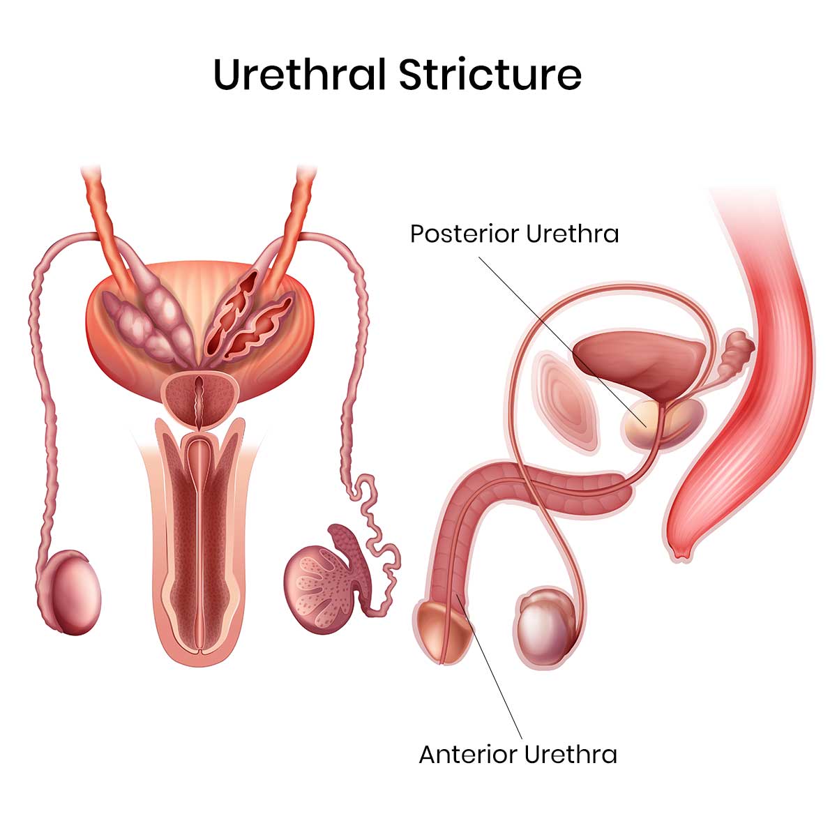 Stricture Urethra Treatment