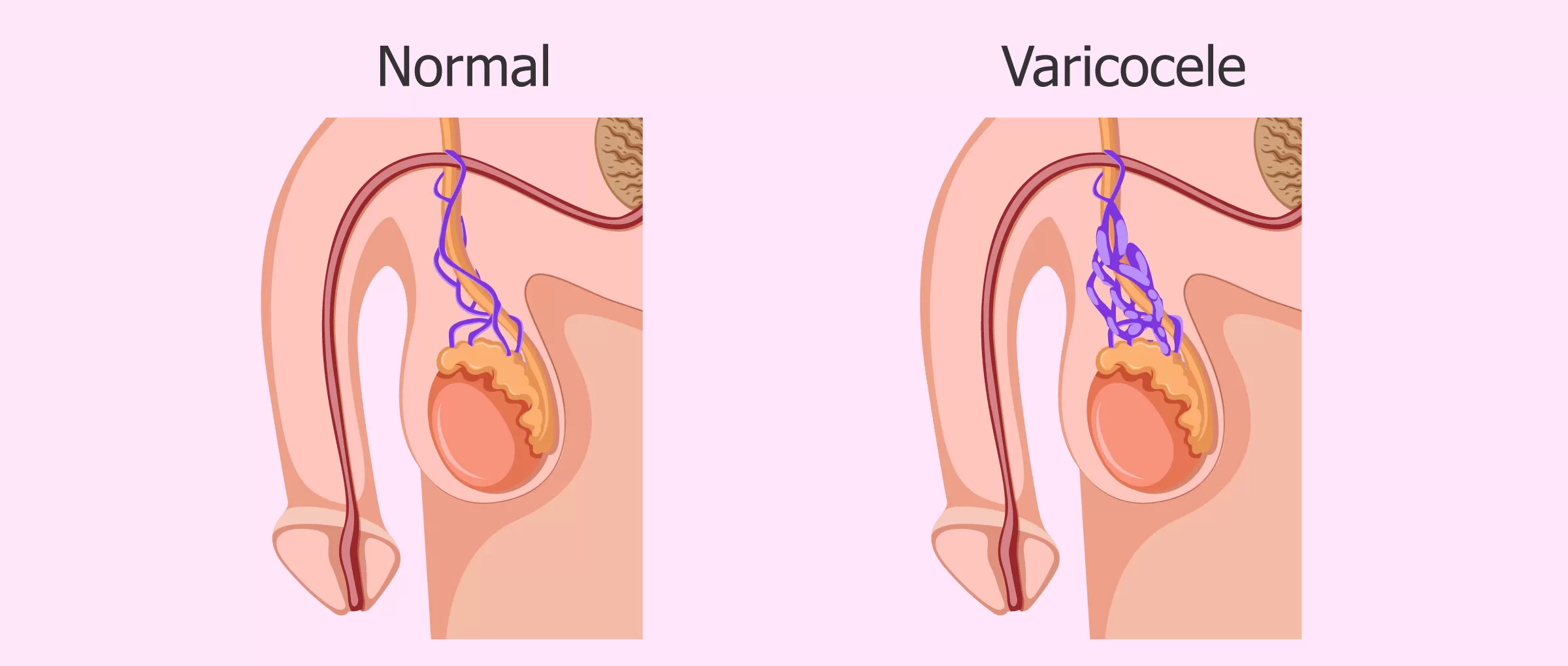 Varicocele Treatment